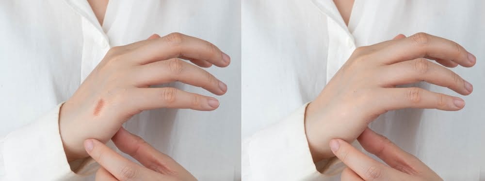 Red Light Therapy for Scar Healing