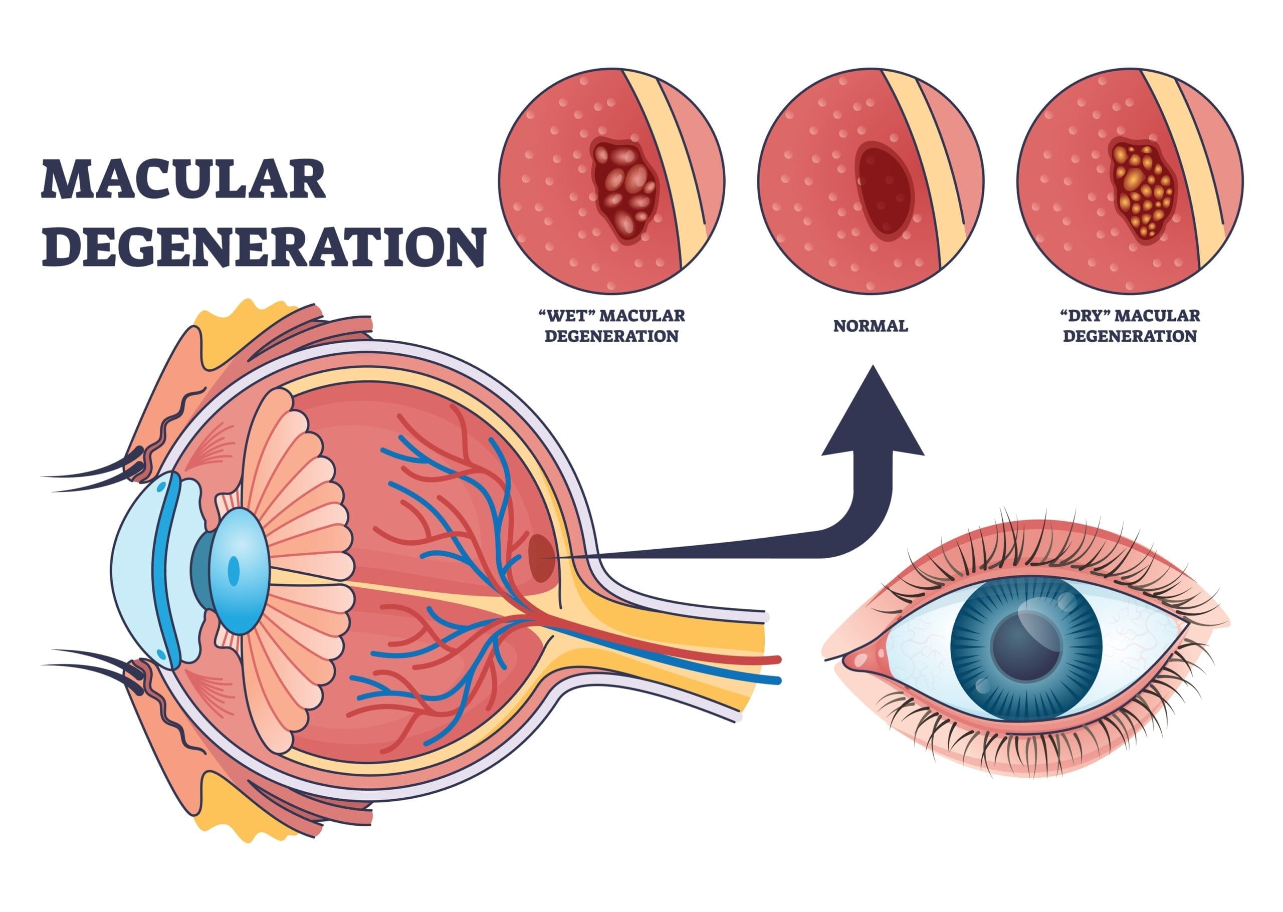 RLT and Dry Macular Degeneration